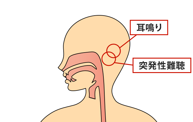 症状の該当箇所のイラスト