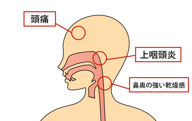 症状の該当箇所のイラスト